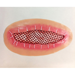 Simulaids 800-655 Skin Graft 6"