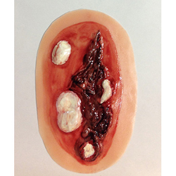 Simulaids 800-635 Smallpox (Double)